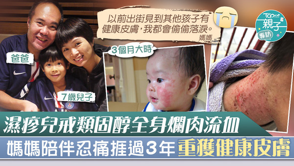 媽媽Peggy陪伴兒子捱過3年戒類固醇的艱苦日子，終讓兒子重獲健康皮膚。