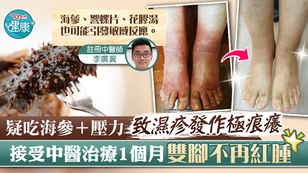 一名婦女疑吃海參後誘發濕疹，近期因壓力大而復發，皮膚極為痕癢。
