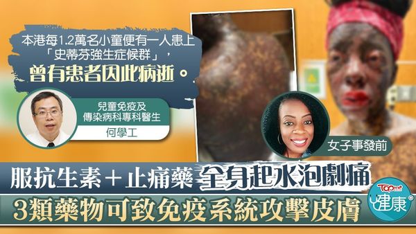 一名女子服抗生素及止痛藥後，全身起黑水泡劇痛。