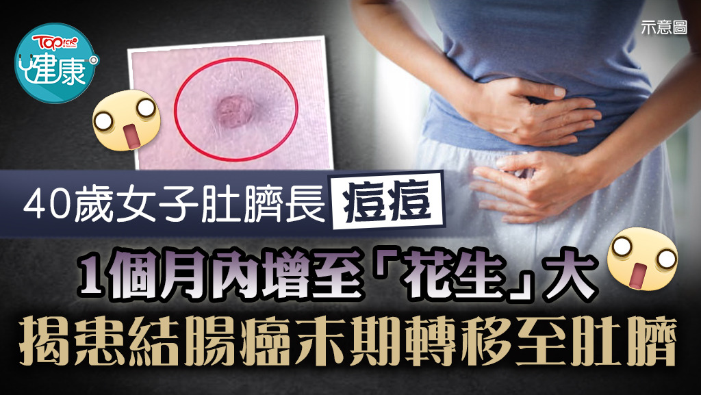 40歲女子肚臍長「痘痘」，揭患結腸癌末期轉移至肚臍。