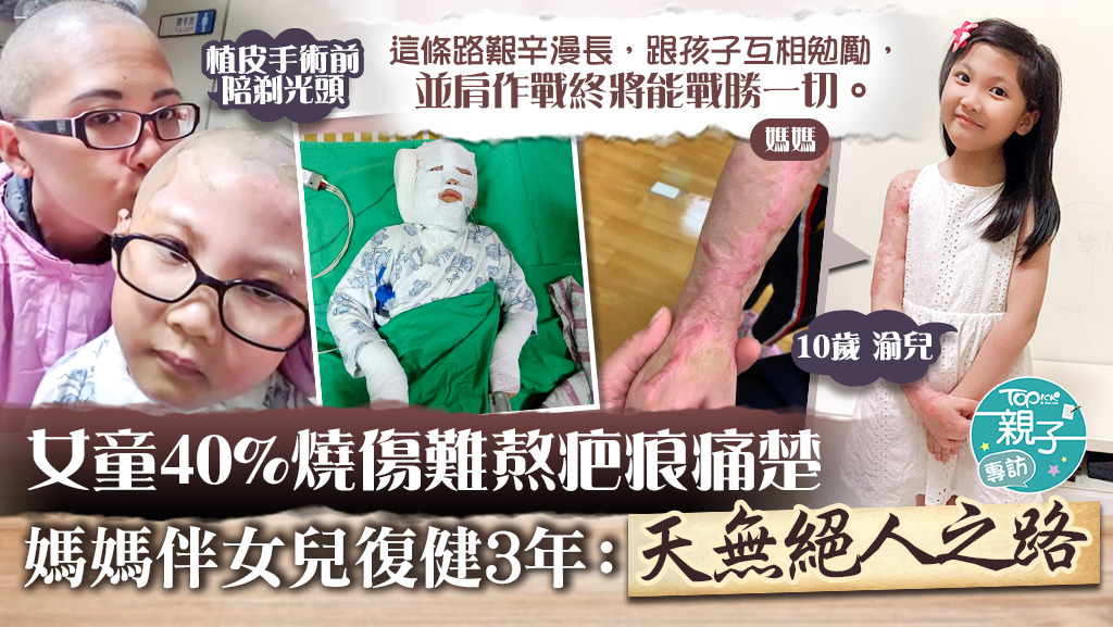 台灣女童渝兒40%燒傷，媽媽伴女兒復健3年重獲新生。