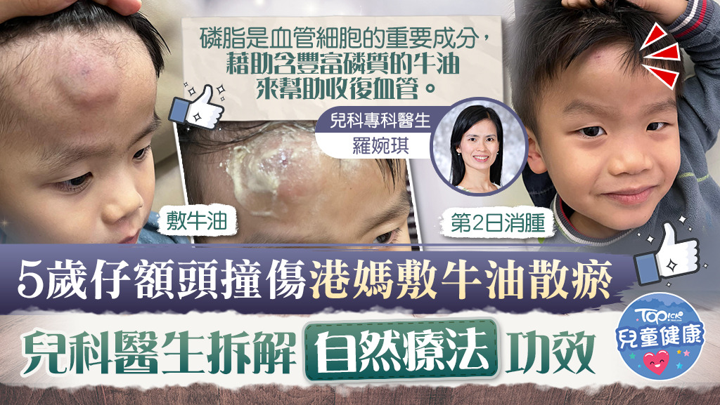 有港媽用牛油成功為兒子額頭散瘀，引起一眾媽媽熱議。