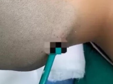男童誤把鉛筆插入後腦。(來源:微博)