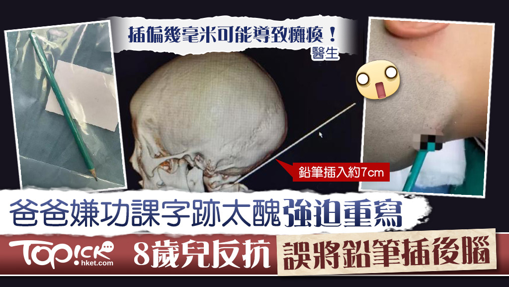 一名8歲男童誤將鉛筆插入後腦。