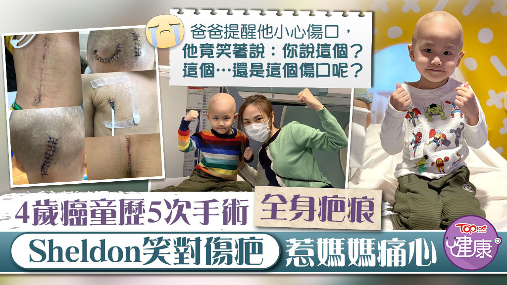 4歲癌童Sheldon歷5次手術，樂觀面對全身疤痕。