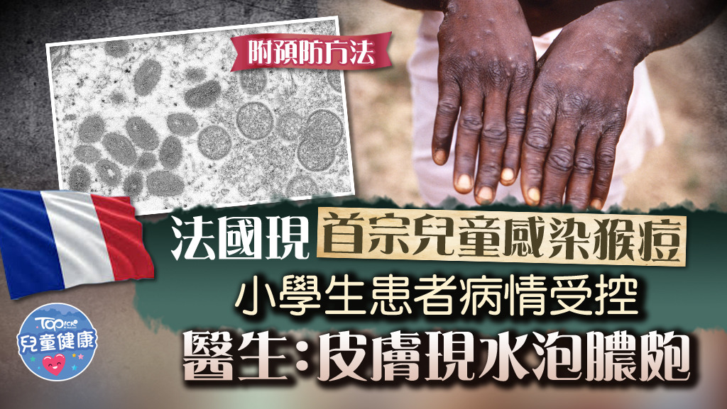 法國有名小學生感染猴痘，屬當地首宗兒童感染猴痘病例。