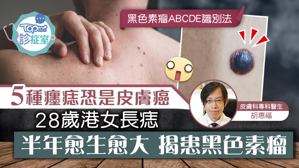 28歲港女長痣，揭患上黑色素瘤。