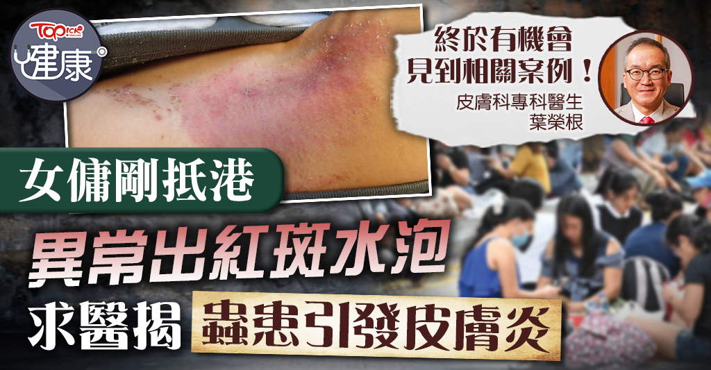 [Mosquito bites]Maid who first arrived in Hong Kong developed abnormal erythema and blisters and sought medical attention, revealing that insects caused dermatitis – Hong Kong Economic Times – TOPick – Health – Doctor’s Consultation Room