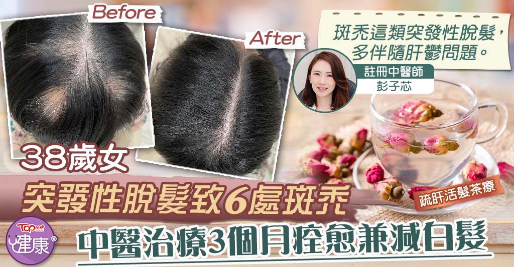 [Hair loss treatment]A 38-year-old woman suffered sudden hair loss and caused 6 alopecia areata in 3 months of traditional Chinese medicine treatment, cured and reduced gray hair – Hong Kong Economic Daily – TOPick – Health – Health and Beauty