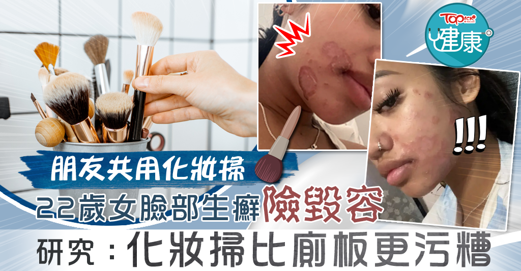 Make-up Brushes: Worse Than Toilet Seats? Woman Shares Brush and Gets Ringworm on Her Face