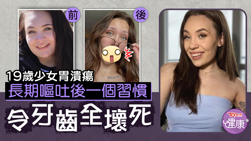 19歲女胃潰瘍嘔吐，誤信1習慣致滿口爛牙受盡歧視。