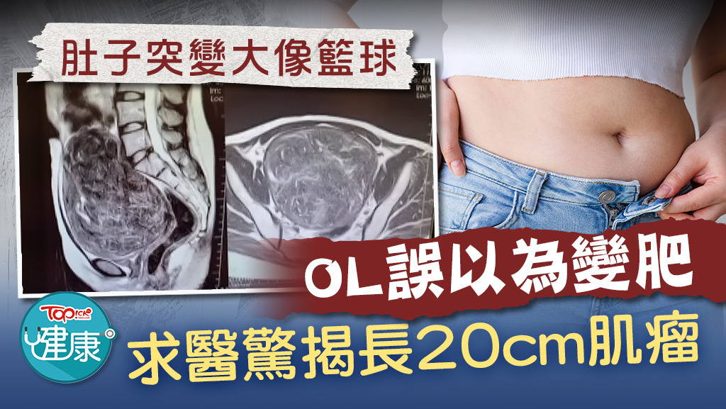 肚子突變大像籃球，OL誤以為變肥，求醫驚揭長20cm肌瘤。