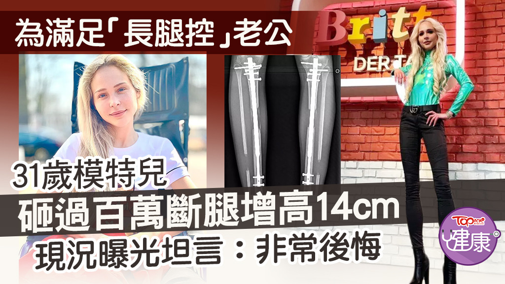 31歲模特兒為滿足「長腿控」老公，砸過百萬斷腿增高14cm曝光現況：非常後悔。