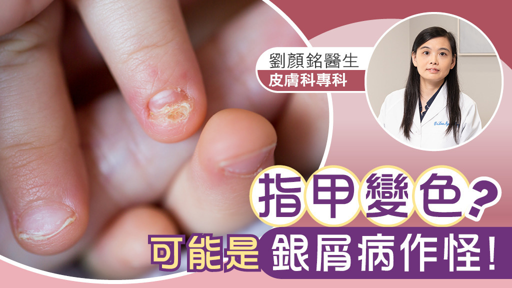 指甲變色？可能是銀屑病作怪！