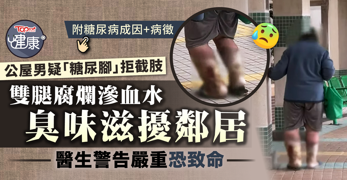 Man in Wong Tai Sin Public Housing Estate Rejects Leg Amputation for “Diabetic Foot” – Risks Fatal Consequences [Diabetes/Diabetic Foot/Wong Tai Sin/Chronic Diseases]