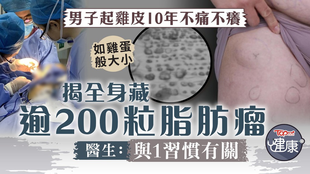 男子起雞皮10年不痛不癢，揭全身藏逾200粒脂肪瘤，醫生：與1習慣有關。