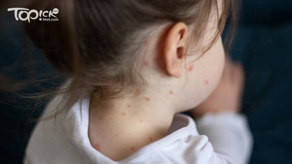 麻疹傳染力極強，嬰幼兒感染可奪命，陳菁兒醫生拆解症狀、傳播途徑、潛伏期。