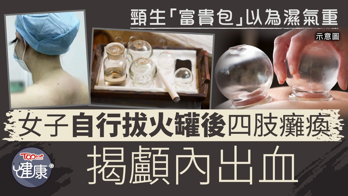 拔罐禁忌︱女子欲袪濕自行拔火罐竟四肢癱瘓大小便失禁揭「顱內出血」【附醫生解說】