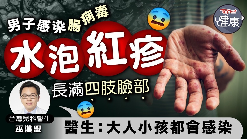 男子感染腸病毒，水泡紅疹長滿四肢臉部，醫生：大人小孩都會感染。
