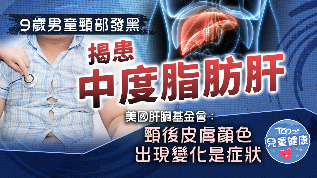  兒童患有脂肪肝的情況越來越普遍。