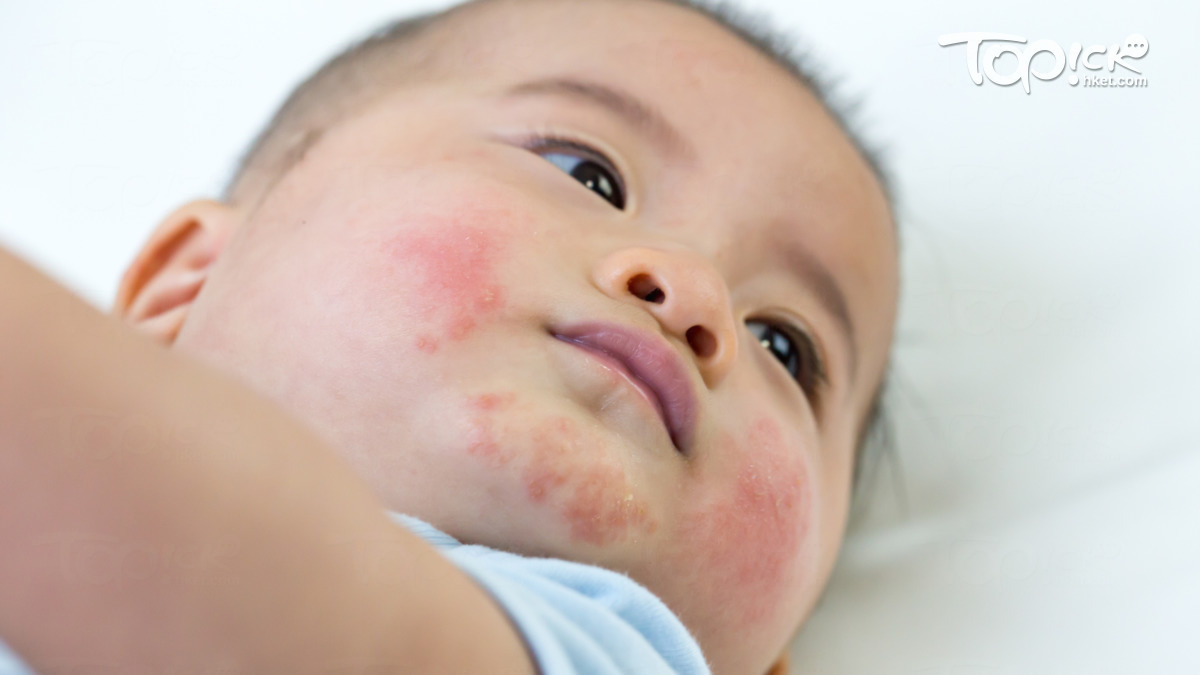Toddler Allergic Eczema