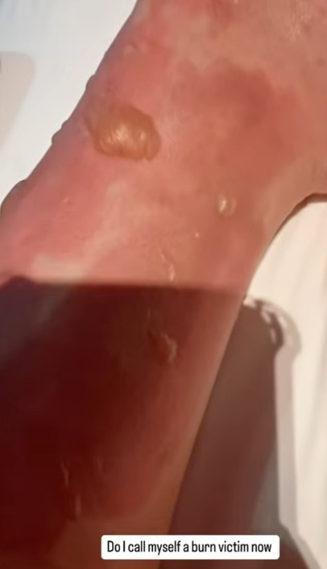 梁齊昕3月4日曾上載自己腳部包紮照片。