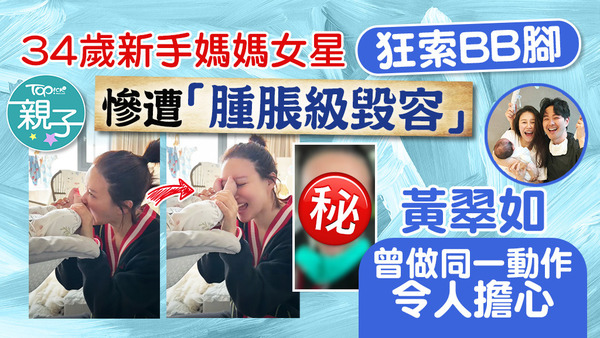 34歲女星狂聞BB腳出事，雙眼嚴重感染「毀容級腫脹」。