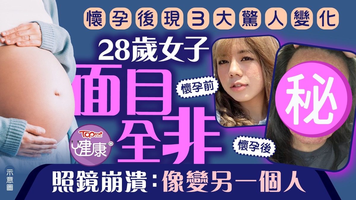 懷孕變化｜28歲女子懷孕後現3大驚人變化面目全非照鏡崩潰：像變另一個人